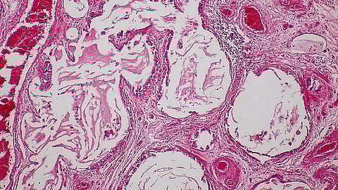 Scleroderma, a Honeycomb fibrosis case.