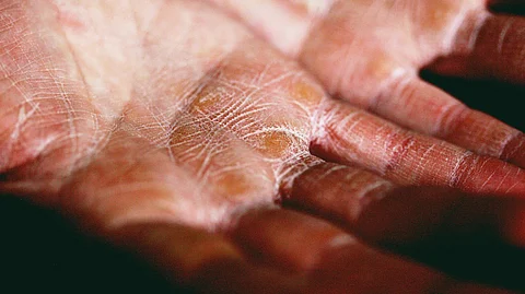 Eczema causes inflamed, irritated, and often itchy skin.