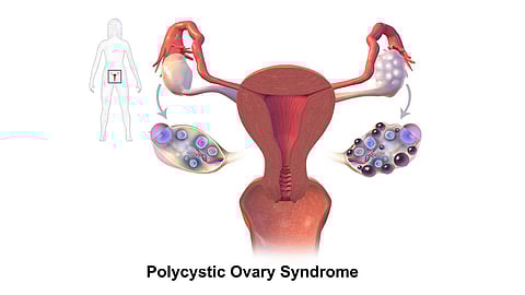 PCOS is a multifactorial condition that results from the interaction between genetic, endocrinological and environmental factors.