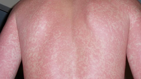 A naked back of a man which shows red rashes all over the skin due to some allergic reaction.