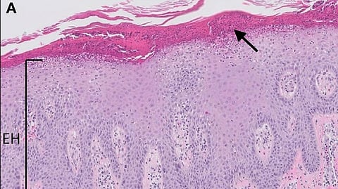 Micrograph of Psoriasis vulgaris.
