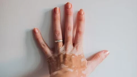 The cream has been called a 'Miracle' cream claiming to treat the autoimmune disease of Vitiligo.