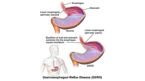 GERD is a multifactorial condition and is caused by several factors such as dietary habits, excessive exercise regimen, smoking, alcohol consumption, obesity, hiatal hernia, pregnancy, H. Pylori infection, and wearing tight-fitting clothes.