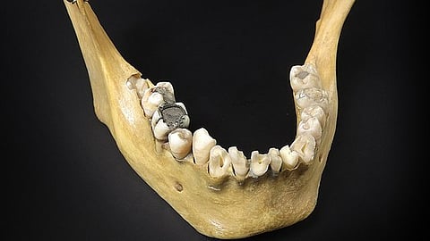 The history of dental fillings has been analogous to the history of modern dentistry.