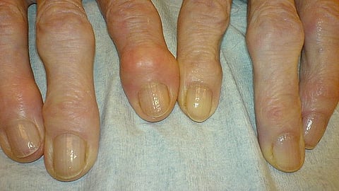 The potential to yield a single long-lasting treatment which is necessary for patient compliance in a chronic disease like osteoarthritis.