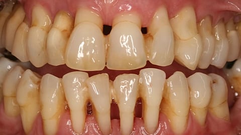 High blood sugar encountered in diabetic patients is the connecting link between diabetes and dental health problems. If diabetes is not controlled within the limiting range, the diabetic patients are prone to develop dental health problems eventually.