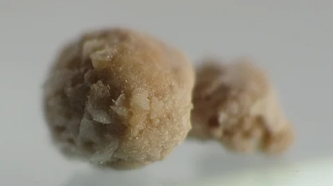 While formation of stones is a common phenomenon in this part of the world, presence of stones in such large numbers often challenges the urologists who operate on such patients.