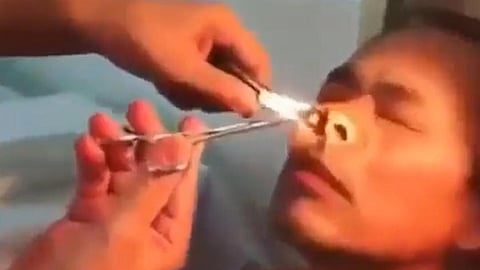 The video shows a doctor pulling out the leech from the man's nose. The leech was a gigantic one as well.