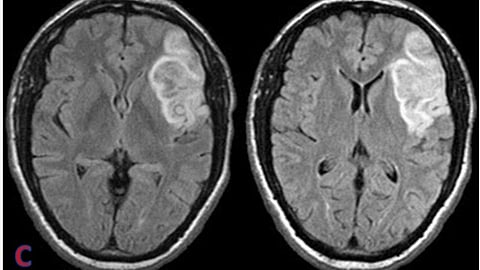 When there is no primary cause and no autopsy performed, cerebral palsy is commonly written as the underlying cause of death.