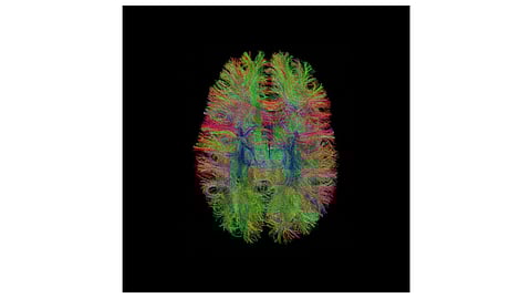 CHD, which refers to one or more abnormalities of an infant’s heart, impacts 40,000 newborns a year in the U.S.