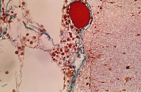 The image shows a significant thrombus in an artery.