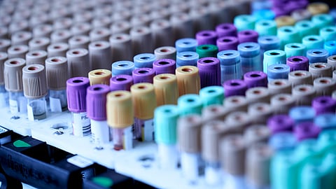 US researchers have successfully developed a blood test for anxiety that examines biomarkers to help doctors objectively determine a person's risk for developing anxiety, its severity and therapies best suited for them.