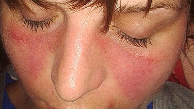 Malar rash, also called butterfly rash in systemic lupus.