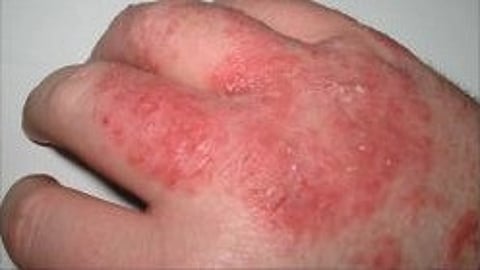 Atopic eczema occurs in 20–30 percent of children