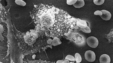 Multiple myeloma is a cancer of the blood and bone marrow