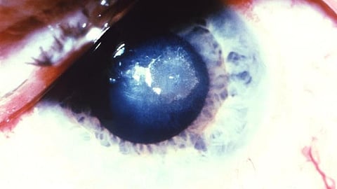 The clinical trials suggest that there's about a 10% risk of developing wet macular degeneration in the first year of treatment with Syfovre.