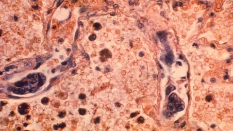 Inflammatory bowel disease (IBD), which includes Crohn’s disease and ulcerative colitis, is a chronic intestinal inflammation that can increase the risk of developing lymph node cancer