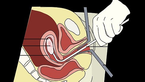 Mifepristone has been approved by the Food and Drug Administration for 23 years