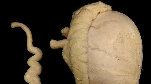 Testicular Torsion is due to a congenital abnormality that causes testicle to twist around its spermatic cord leading to ischemia and infarction of the testicle.