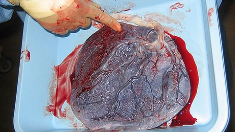 The secret of the genetics of schizophrenia has been hiding in plain sight -- the placenta, the critical organ in supporting prenatal development