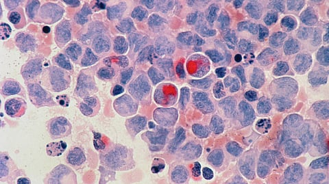 The patients received bone marrow transplants to treat leukemia, and the transplanted donor cells contained mutations that inactivated the CCR5 gene