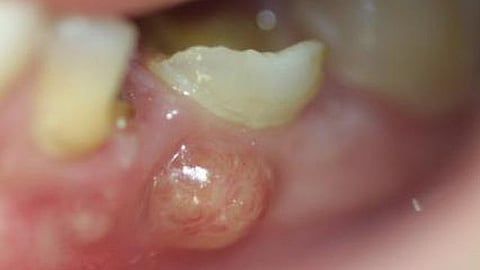 Dental abscesses