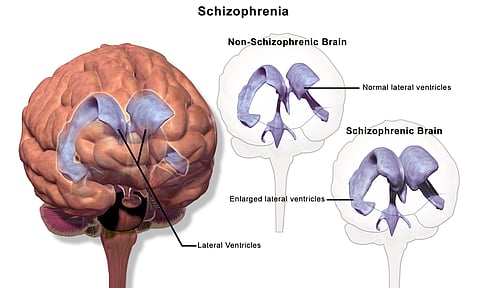 Lobes that schizophrenia effects