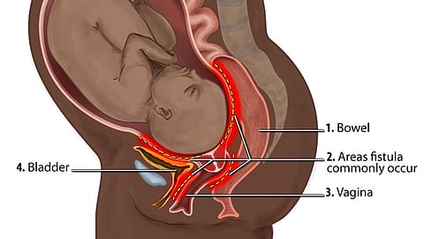 Obstetric fistula is a hole between the birth canal and bladder or rectum, caused by prolonged, obstructed labor without access to timely, high-quality medical treatment.