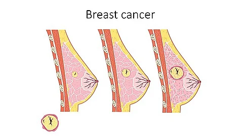 Both trastuzumab deruxtecan and trastuzumab emtansine are antibody-drug conjugates, a relatively new type of drug that delivers chemotherapy directly to the cancer cell, minimizing damage to normal tissues.