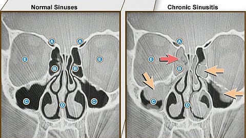 Sinusitis can be divided into acute and chronic forms. In particular, the chronic forms (>12 weeks duration) are often challenging in the context of therapy. (Wikimedia Commons)