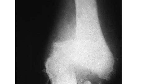 Manual therapy is a non-invasive and hands-on approach that is often used as part of a comprehensive treatment plan for individuals with knee osteoarthritis. (Wikimedia Commons)
