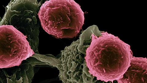 Sarcoma can grow in bones, muscles, tendons, cartilage, and any connective tissue, which makes it a difficult disease to detect. (Unsplash)