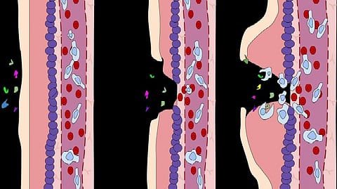 ALS is a progressive neurodegenerative disease that affects the nerve cells in the brain and spinal cord and cause autoimmune inflammation. (Wikimedia commons)