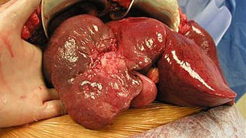 The randomized controlled study was conducted by 15 liver transplant centers in the United States (Representational Image: Wikimedia Commons)