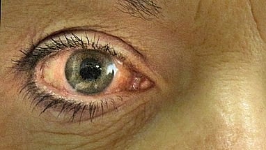 Acute angle glucoma (Wikimedia commons)