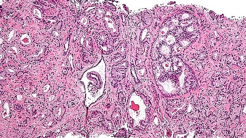 Prostate cancer with Gleason pattern (Wikimedia Commons)