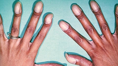 Digital clubbing with cyanotic nail beds in an otherwise healthy-appearing, asymptomatic young adult is characteristic of a congenital cardiac anomaly with right-to-left shunting. (Wikimedia Commons)