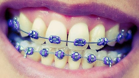 Be prepared that taking care of your teeth will be more difficult once orthodontic treatment starts. (Wikimedia Commons)