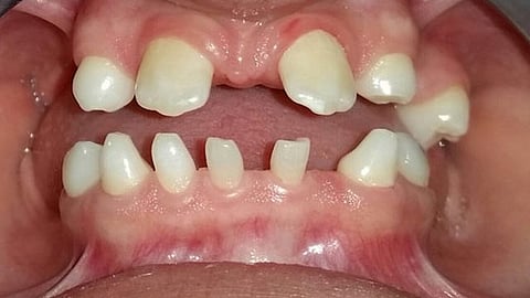 Anodontia is the condition of complete absence of teeth , as they lack developing tooth bud and the condition often appears alongside genetic disorders, like ectodermal dysplasia. (Wikimedia commons)