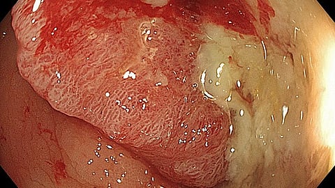 Mutations In Blood Stem Cells Can Exacerbate Colon Cancer (Representational image: Wikimedia commons)