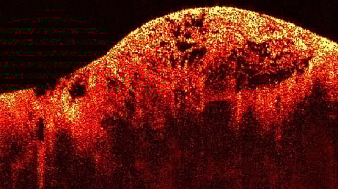 Optical Coherence Tomography (Representational Image: Wikimedia Commons)