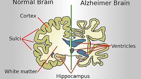 People who carry the gene variant associated with the strongest risk for Alzheimer’s disease may lose their ability to detect odors earlier than people who do not carry the gene variant.(wikimedia commons)