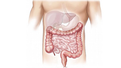 Bile acid diarrhea (BAD) is usually seen in patients with ileal Crohn's disease or ileal resection. (Pixabay)