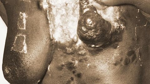 Breast cancer is the leading cause of cancer-related deaths for Black women, underscoring the need to address this public health challenge. (CDC PHIL)
