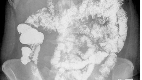 Development of experimental drug in Johns Hopkins can reduce symptoms of IBD. (MedPix)