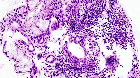 Histopathologic image of focal lymphoplasmacytic infiltration in the minor salivary gland associated with Sjögren syndrome. Lip biopsy. H & E stain (Wikipedia Commons)