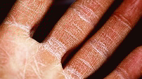 In fact, you could have both eczema and psoriasis at the same time, but it’s rare (Representational Image: Unsplash)