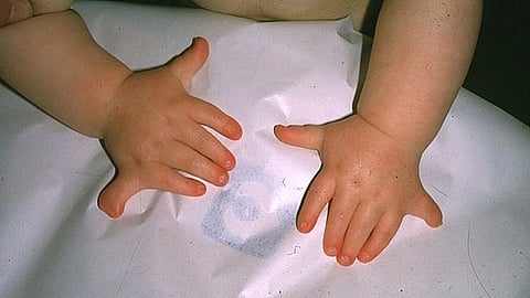 Baby born with 26 fingers in Rajasthan (Representational image: Wikimedia Commons)