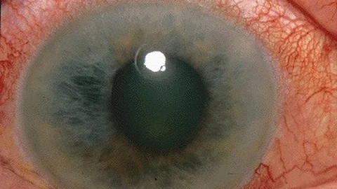 Glaucoma is a common eye disease that damages the optic nerve and thereby the field of vision. In the most serious cases, glaucoma can lead to blindness.(Representational Image: Wikimedia commons)