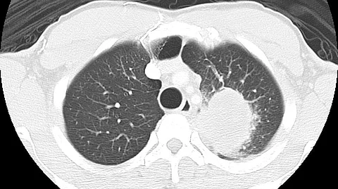 Preoperative Staging of Non-Small-Cell Lung Cancer with Positron-Emission Tomography (MedPix)
